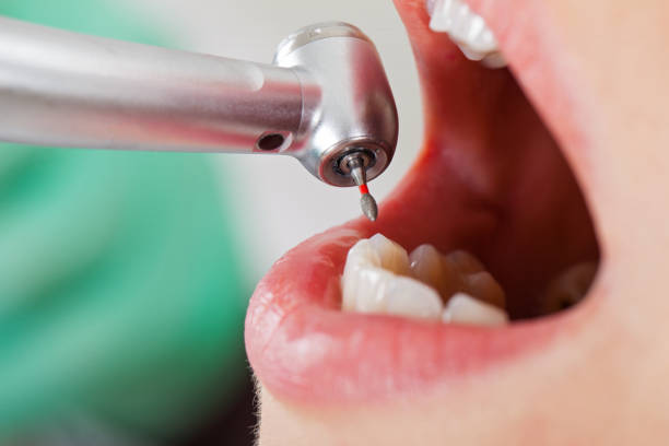 Best Emergency Dentist for Lost Fillings or Crowns in Boulder Hl, IL